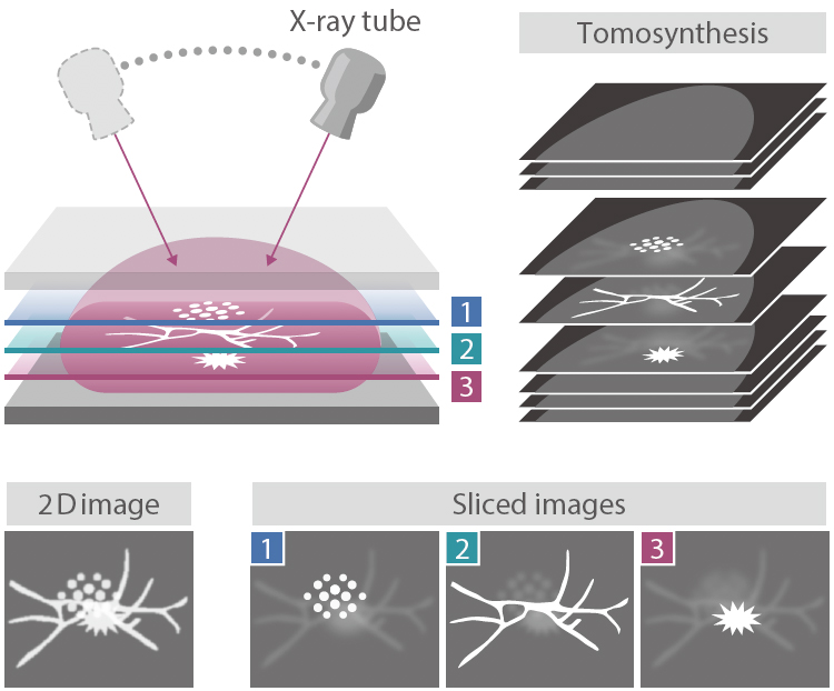 Images were shot at different angles to produce 1mm slices to minimize the effect of overlap for 3D Tomosynthesis Mammography